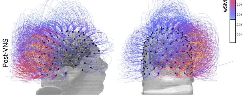 This image provided by the CNRS Marc Jeannerod Institute of Cognitive Science in Lyon, France, shows brain activity in a patient before, top row, and after vagus nerve stimulation. Warmer colors indicate an increase of connectivity.